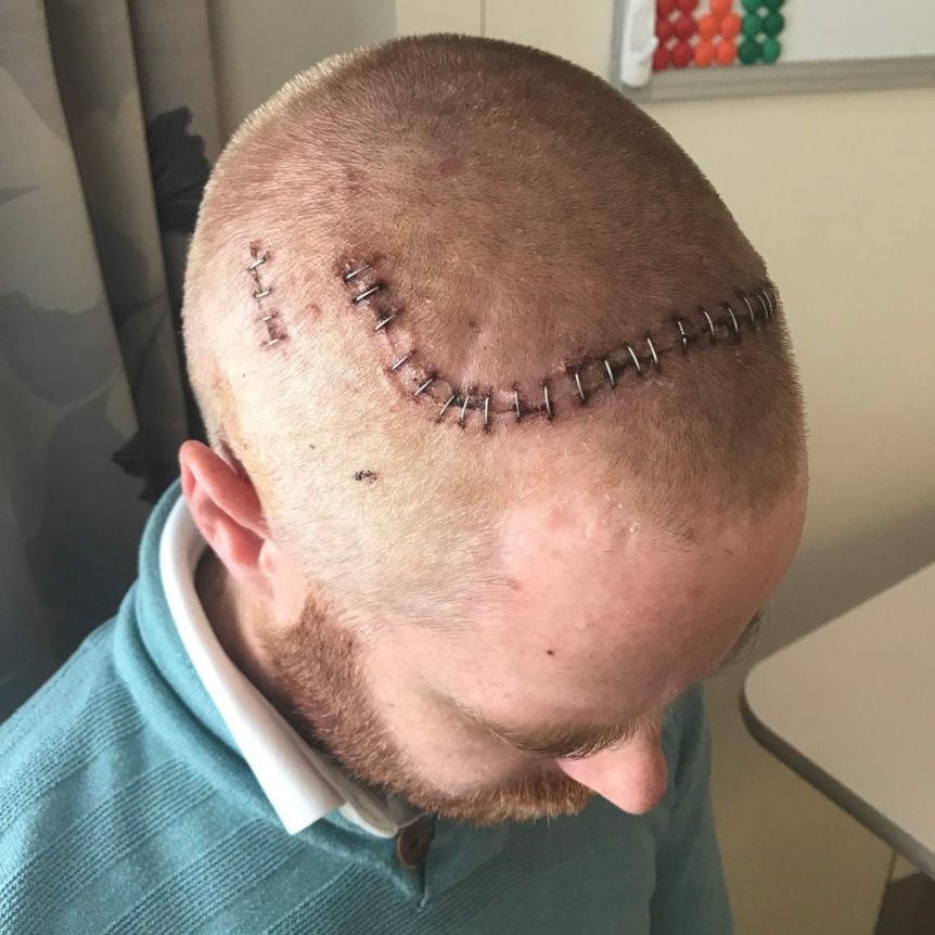 Todd Murfitt with a scar on his head kept together with staples after brain surgery